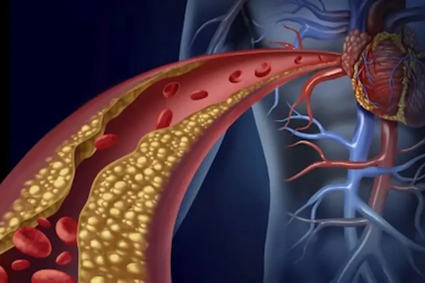 Hyperlipidemia, Η υπερλιπιδαιμία